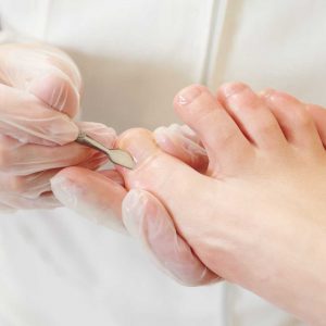 Uña encarnada por surco, incluye 1 curación (Podología)